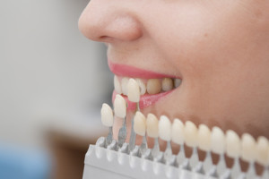 faccette-dentali-a-Rimini
