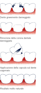 corona dentale